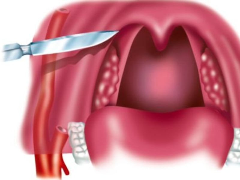 Περιαμυγδαλικό απόστημα