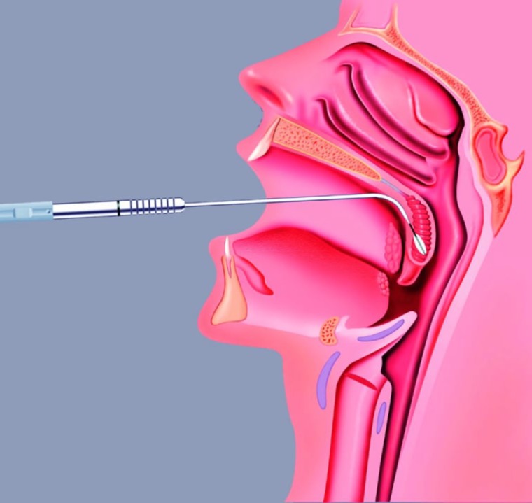 Αδενοειδεκτομή