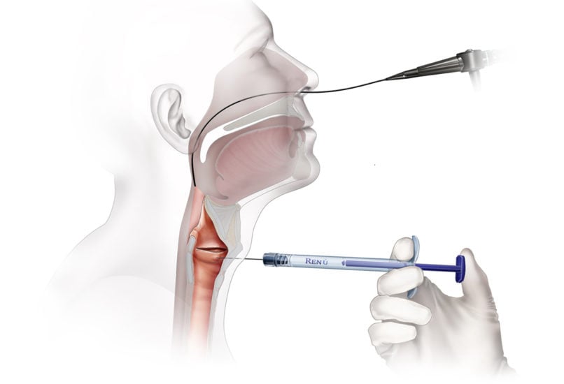 Φωνομικροχειρουργική για παθήσεις φωνητικών χορδών