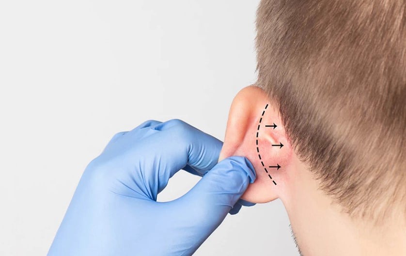 Διόρθωση λοβίου ωτός