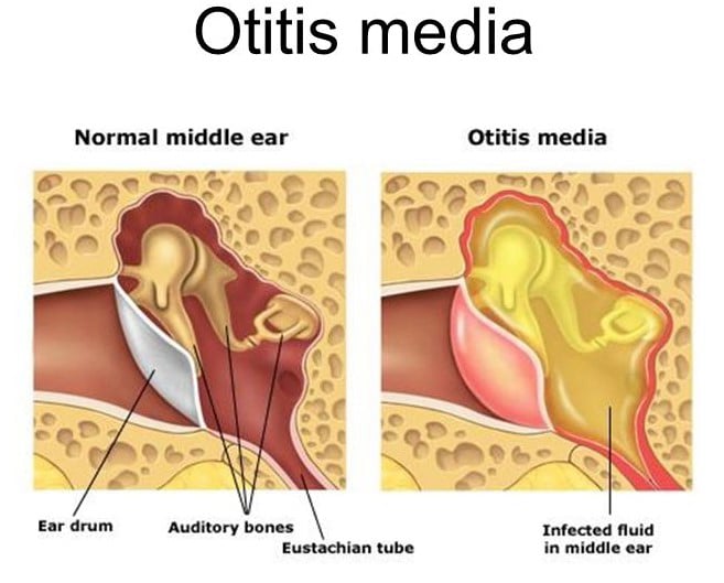 Μέση Ωτίτιδα