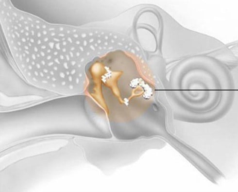 Εγχείρηση ωτοσκλήρυνσης