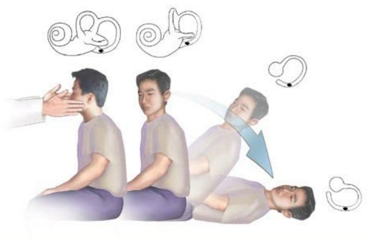 Καλοήθης Παροξυσμικός ίλιγγος θέσεως