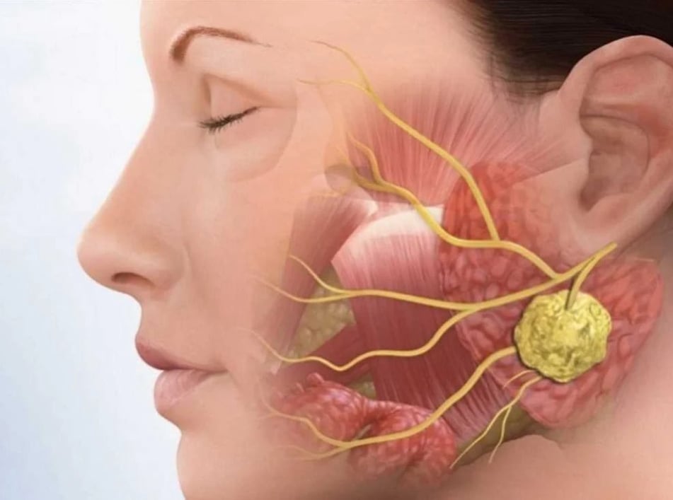 Παρωτιδεκτομή