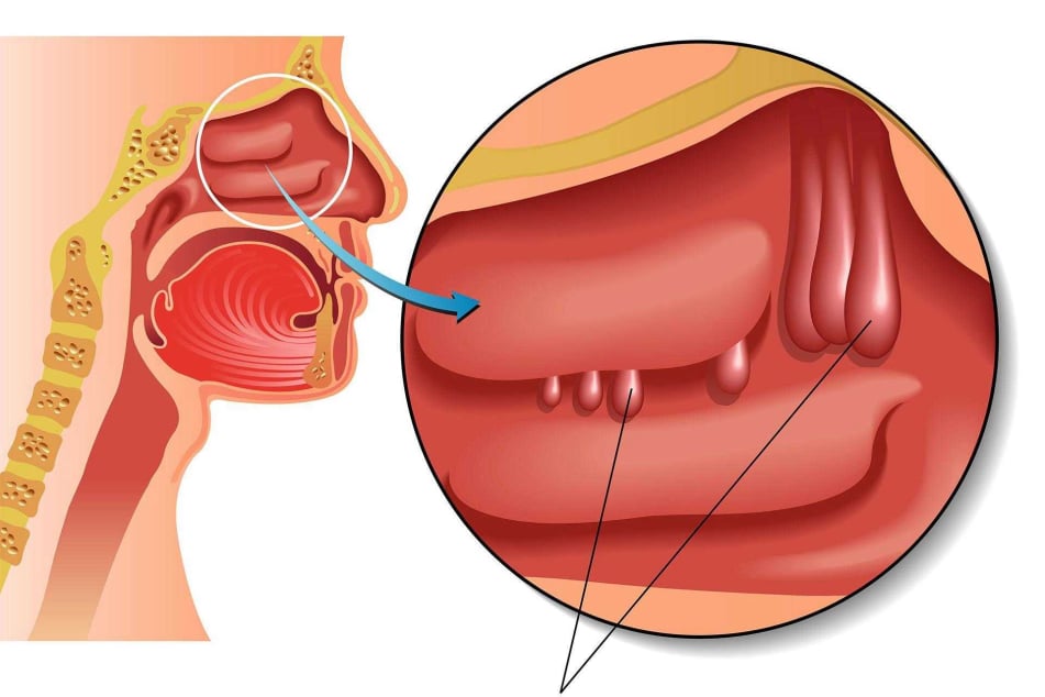 Ρινικοί πολύποδες