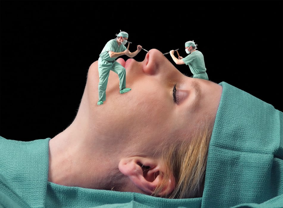 Ρινοπλαστική