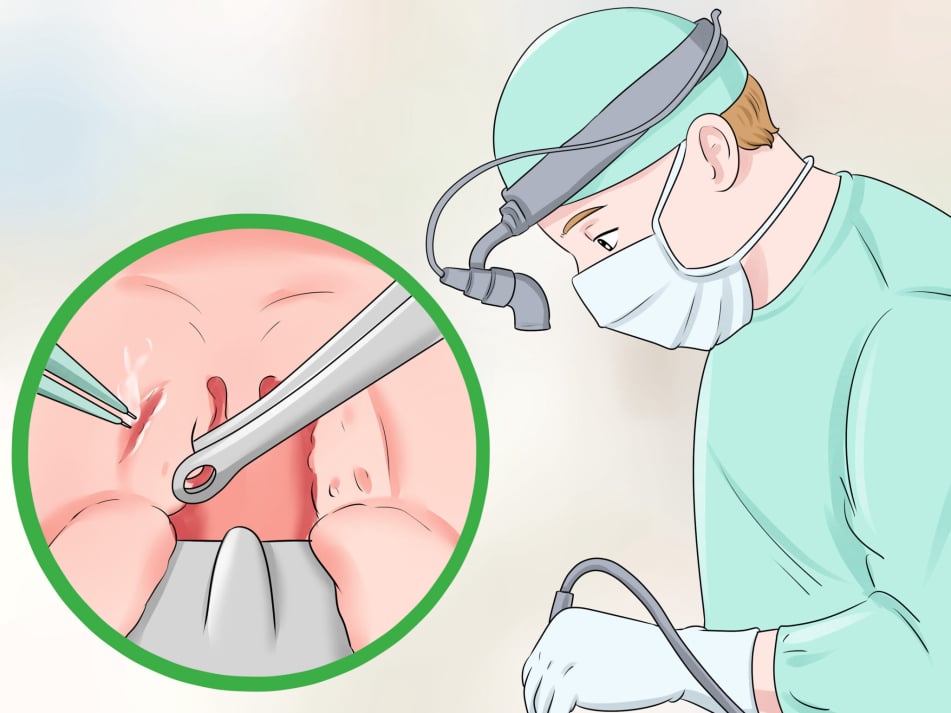 Εγχείρηση ροχαλητού