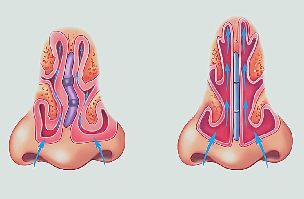 Σκολίωση Ρινικού Διαφράγματος