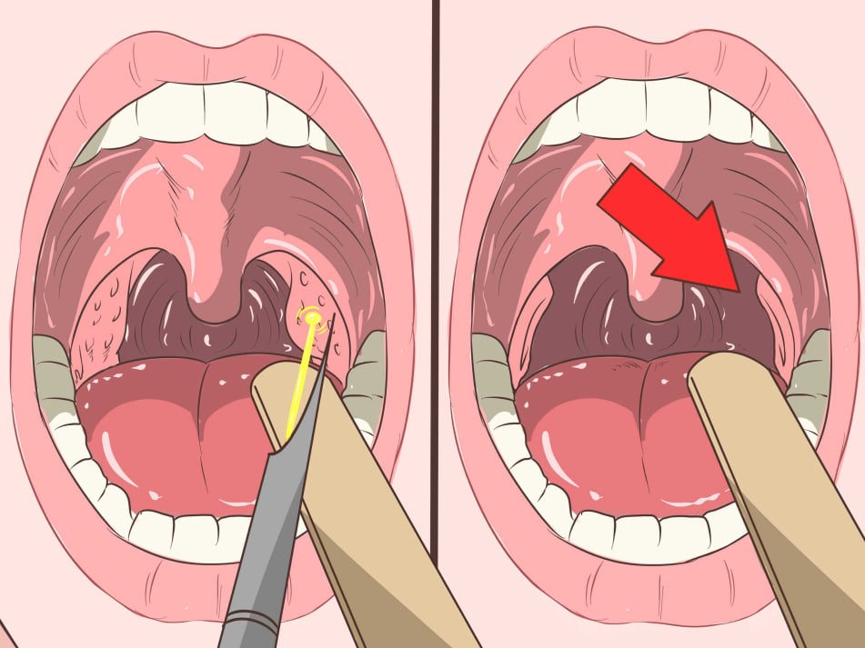 Αδενοτομή (κρεατάκια)