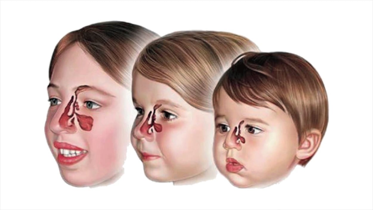 Υπερτροφία ρινικών κογχών